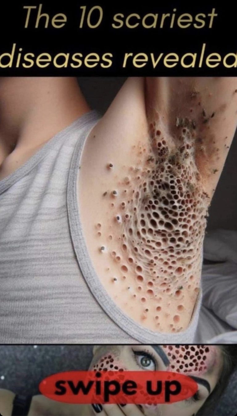 Pimples on Arms