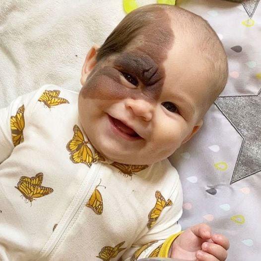 Parents’ Love Drives Them to Remove Daughter’s Birthmark