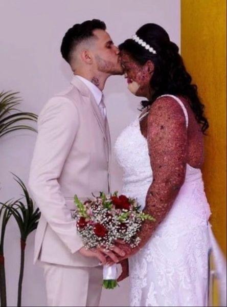 Woman with rare skin condition overcomes negativity and finds true love